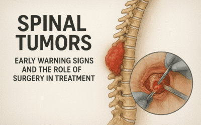 Spinal Tumors: Early Warning Signs and the Role of Surgery in Treatment